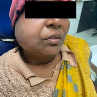 Facial Cellulitis Before Treatment